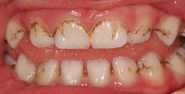 Mon enfant a des taches noires sur les dents, est-ce grave ?