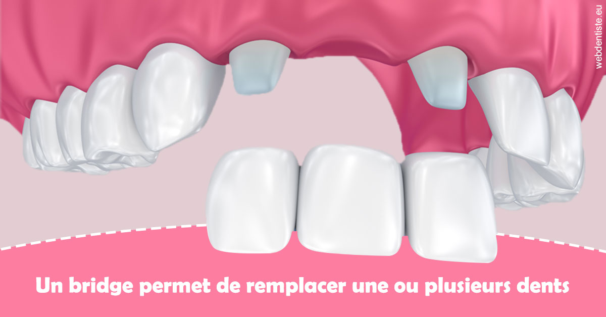 https://dr-amory-christophe.chirurgiens-dentistes.fr/Bridge remplacer dents 2