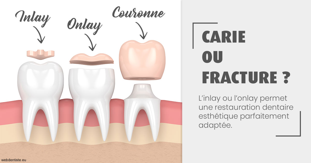 https://dr-amory-christophe.chirurgiens-dentistes.fr/T2 2023 - Carie ou fracture 1