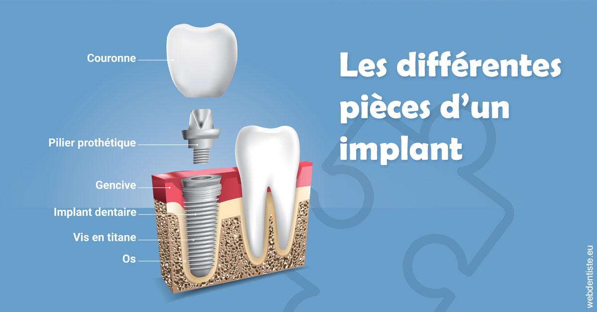 https://dr-amory-christophe.chirurgiens-dentistes.fr/Les différentes pièces d’un implant 1